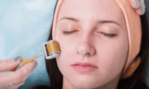 Microneedling Treatment