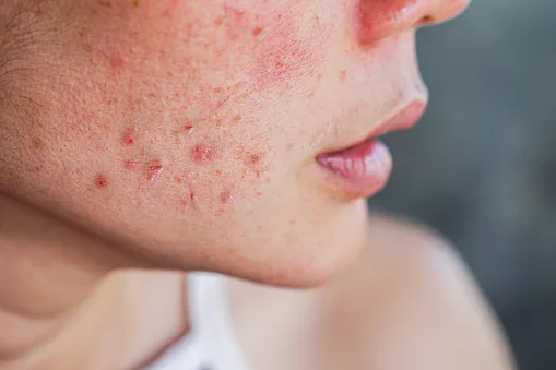 Acne scar specialist, Acne scar specialist in Pune, Acne scar specialist In Kharadi, Acne scar treatment in pune, Acne scar treatment in Kharadi, Acne scar treatment
