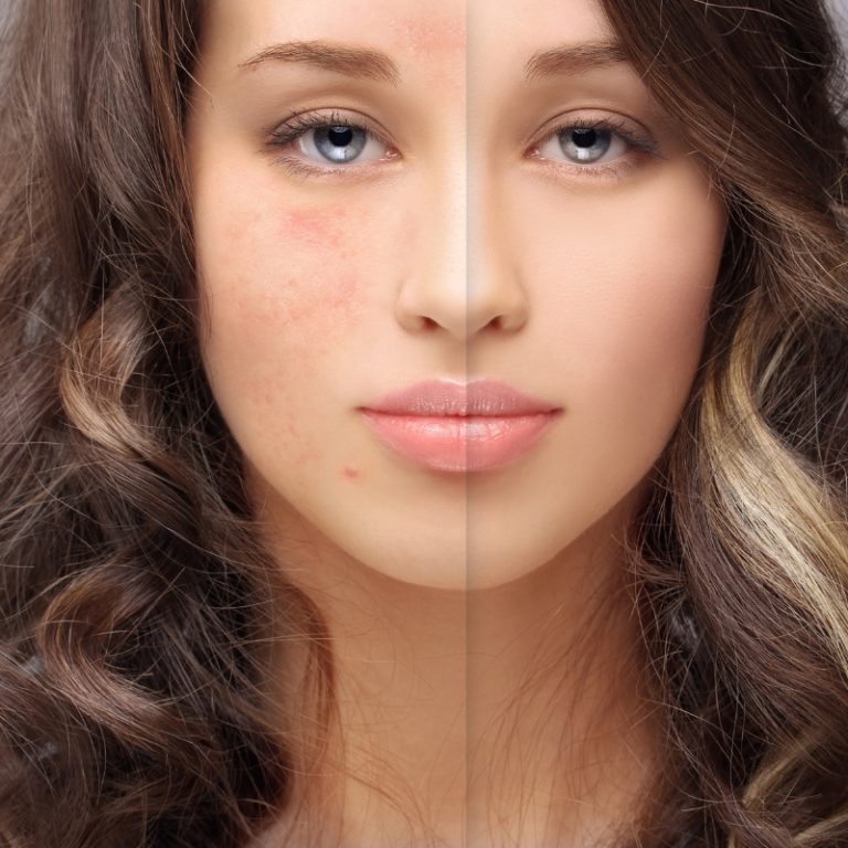Scars Fading Away: Journey to Acne Scar Recovery
