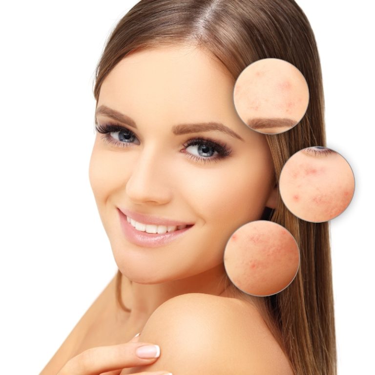 Achieving Clear Skin: Your Guide to Finding the Best Acne Scar Specialist in Pune